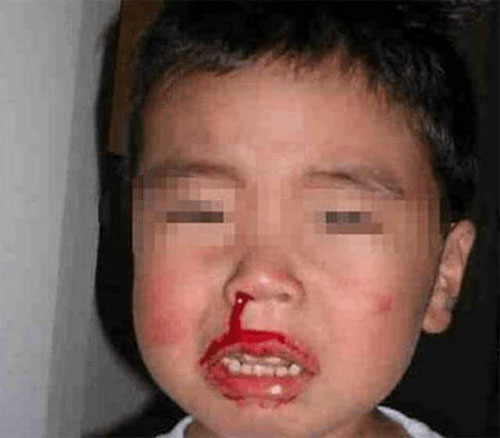 Sơ cứu sai cách đã khiến cậu bé Trung Quốc không may mất mạng (Ảnh minh họa).
